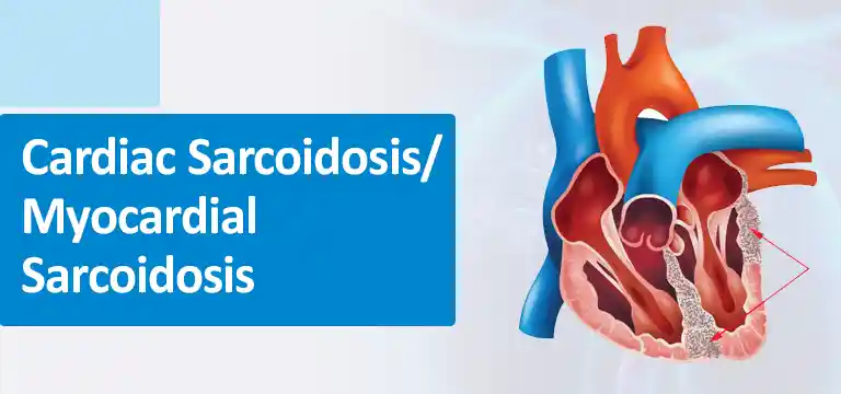 Uses of Pet Scan in Cardiac Sarcoidosis/ Myocardial Sarcoidosis